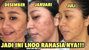 Rahasia Ampuh Hilangkan Bekas Jerawat Dalam 7 Hari!